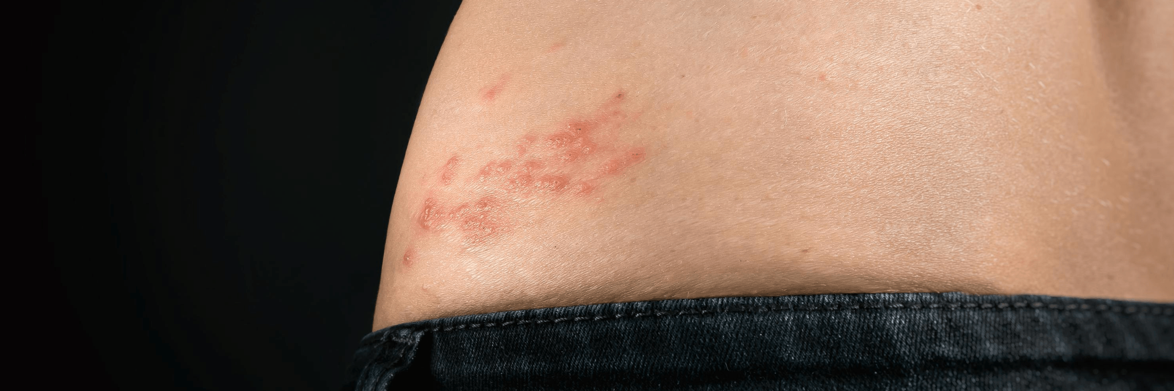 Herpes Zoster: 5 alternative naturali per il trattamento