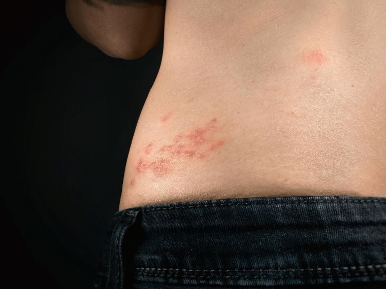 Herpes Zoster: questi 5 rimedi naturali sono di aiuto nel trattamento | Herbano