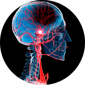 Durchblutungsstörungen im Gehirn: Schlaganfall